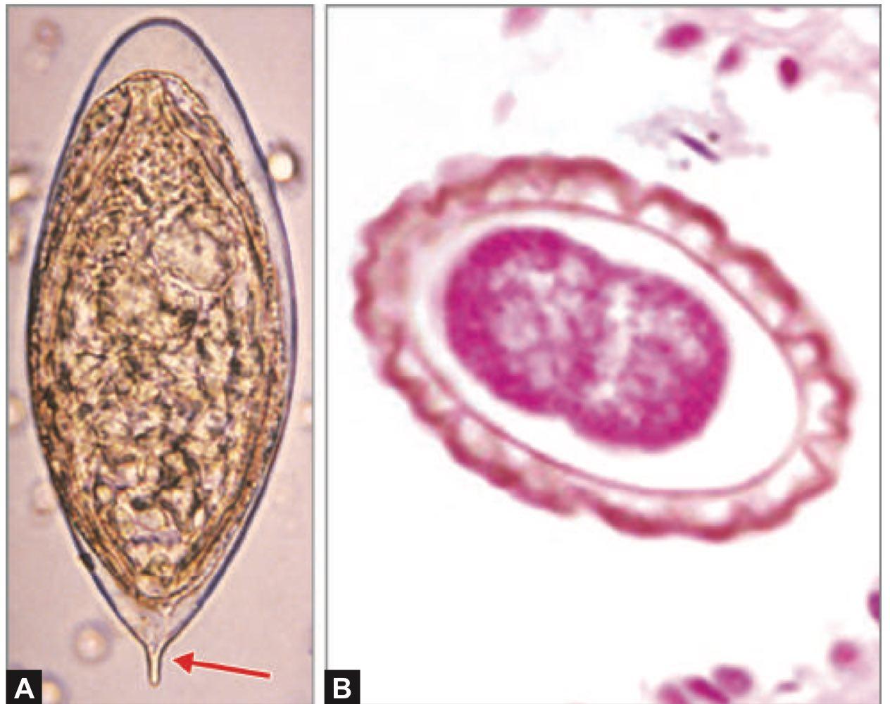 A patient presents to the hospital with complaints of abdominal pain. A stool examination was done, and it showed the presence of the organism shown in image A. The body has segments broader than the length. Which of the eggs shown in column B corresponds to this organism?