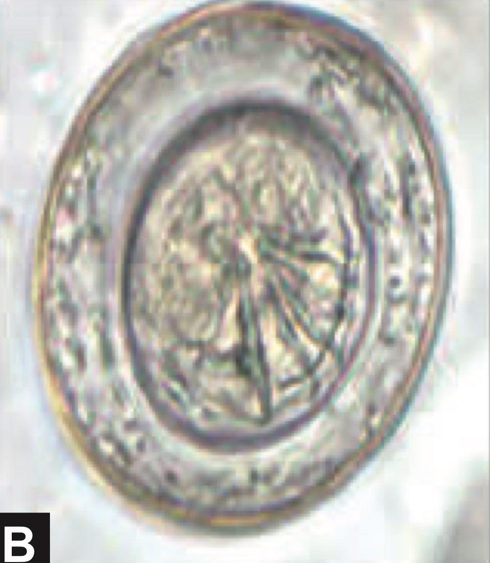 A patient presents to the hospital with complaints of abdominal pain. A stool examination was done, and it showed the presence of the organism shown in image A. The body has segments broader than the length. Which of the eggs shown in column B corresponds to this organism?