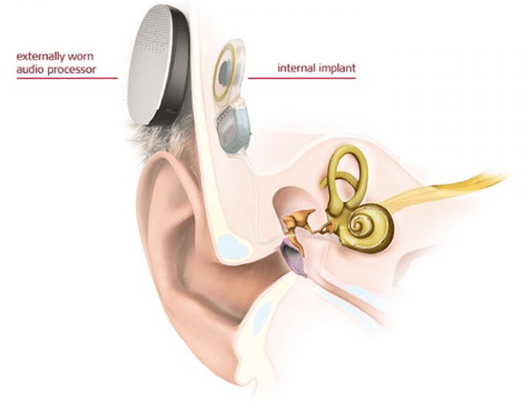 Which of the following devices can be used in a patient with bilateral external auditory canal atresia?