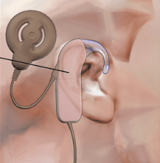 Which of the following devices can be used in a patient with bilateral external auditory canal atresia?